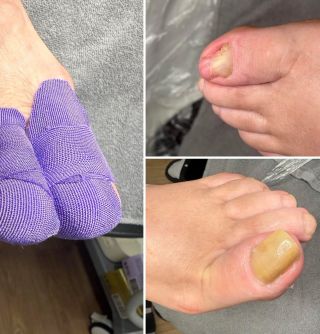 ABRAZE Hluboká abraze je součástí pedikúry, jedná se o odborné ošetření nehtu postiženého onychomykózou (plíseň nehtu),...